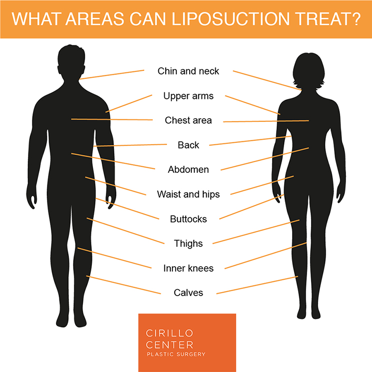 See what can be done with liposuction at the Philadelphia area’s Cirillo Center for Plastic Surgery.